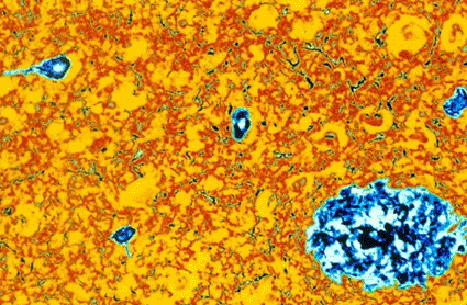 Imagen: Microfotografía de luz a color de tejido cerebral de un paciente con enfermedad de Alzheimer mostrando una placa grande (azul) que contiene la proteína anormal, amiloide (Fotografía cortesía de Simon Fraser / SPL).